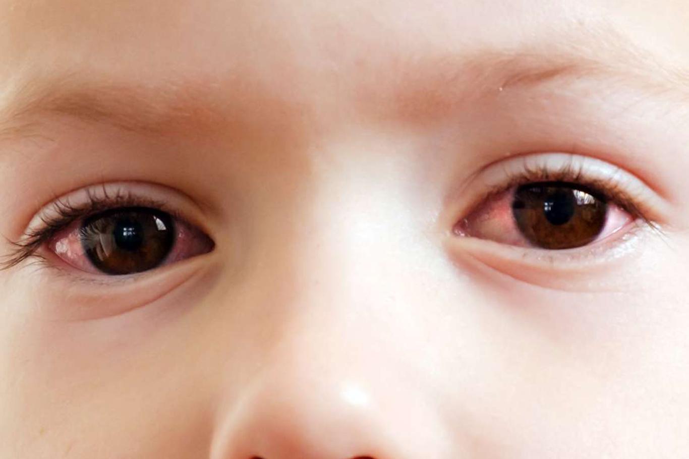 Конъюнктивит ребенка 7 лет. Розовый цвет глаз у младенцев. Pink Eye Kids.