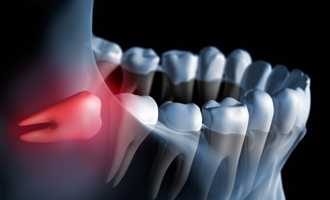 20'lik diş ne zaman çıkar? Yirmilik diş ağrısı nasıl geçer? 20'lik diş ağrısına ne iyi gelir?