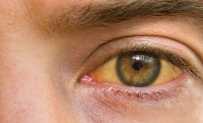 Gözlerde oluşan sarılığa dikkat!